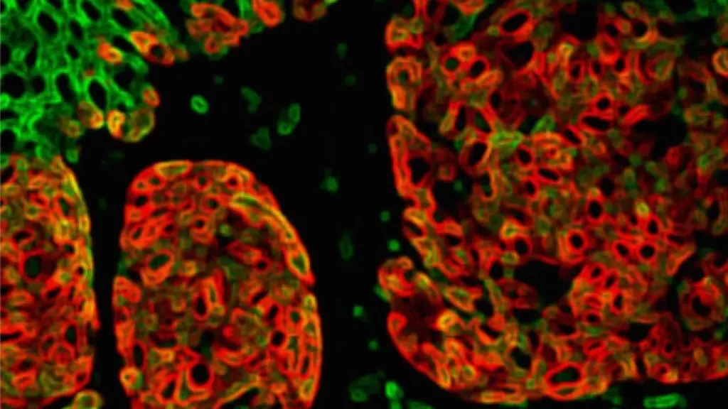 Närbild på cancercell.