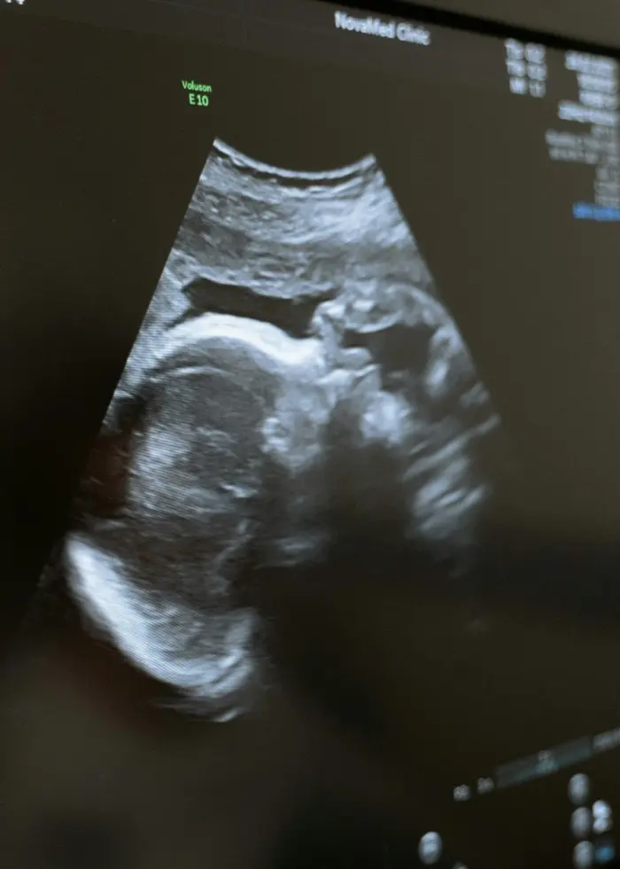 En ultraljudsbild visas på en datorskärm i en medicinsk miljö. Bilden visar detaljer av ett foster i svartvitt, med medicinska data synliga på skärmen. Fokus ligger på monitorn.