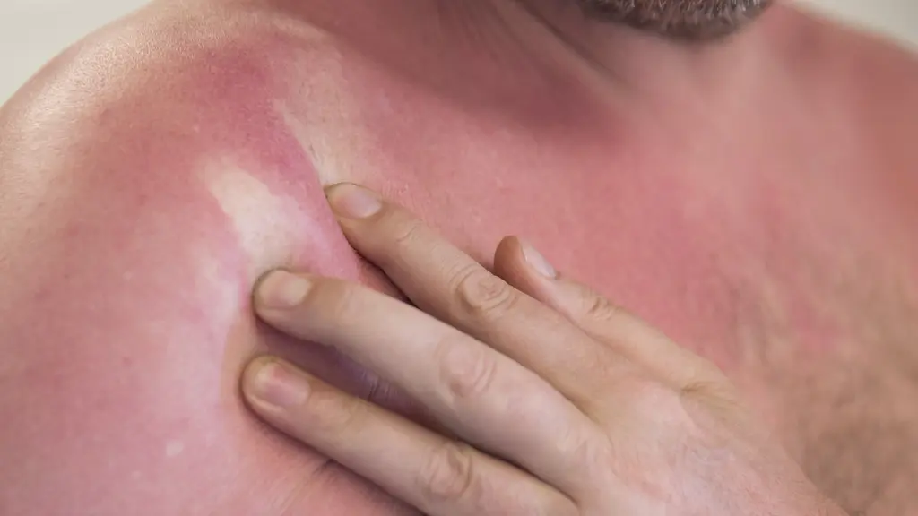 Mycket rödbränd hud och en hand som drar på solbrännan så det bildas vita streck i allt det röda. 