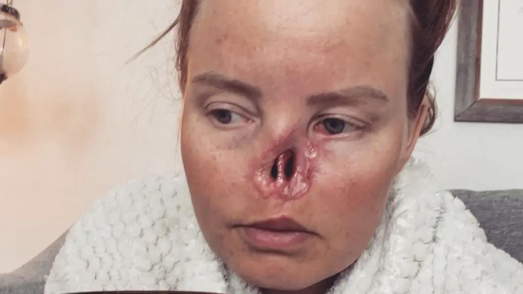 Charlotta med ett hål i ansiktet 