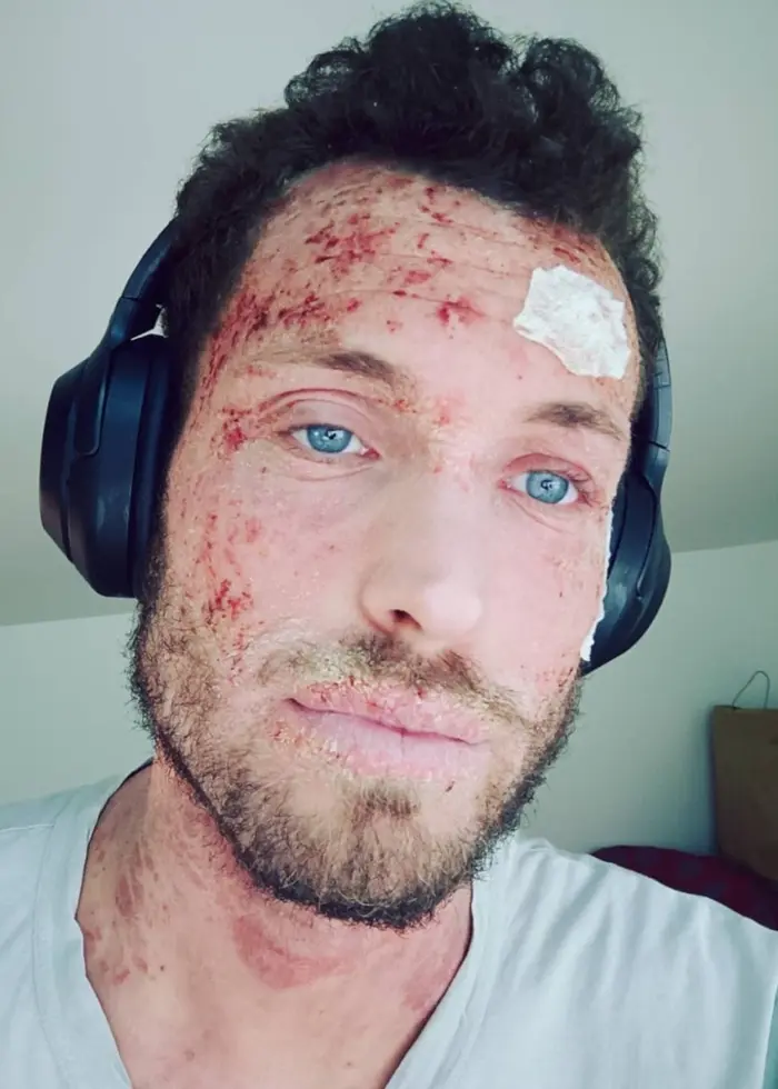 En bild i två delar: Till höger syns en man, Lukas Löfgren, med ett sårigt ansikte orsakat av eksem. Han har kort mörkt hår och bär svarta hörlurar och en grå t-shirt. Till vänster syns samma man i en mörk jacka utomhus, med ett ansikte utan eksem.